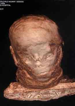 The mummy's head with the bandages in place. Pictures courtesy of Addenbrooke's Hospital.