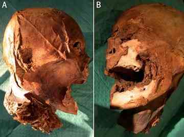 The mummified head of Henry IV. Credit: Gabet/Belet/Galaxy & the British Medical Journal.