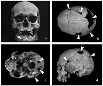 Unearthing prehistoric tumors: a continuing debate