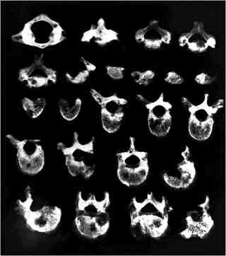 An X-ray of vertebrae from a 50–to 60–year–old man exhumed from an early medieval cemetery in Slovakia showed damage from what paleopathologists believe was metastatic carcinoma – a cancer that began in the soft tissues of the body and spread to the bone. 