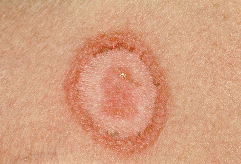[phototake_ringworm_lesion[7].jpg]