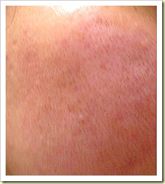 eCO2 Fractional Laser Post treatent Day 5