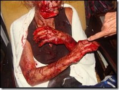 Viljoenskroon farm attack victim panga injuries Jan 25 2010 pic Carien Somers Dippenaar Facebook_thumb[4]