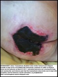 BRONKHORST Chris pressure sores caused by neglect hospice attack victim dies Apr242011