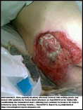 BRONKHORST Chris pressure wounds maltreatment hospice dies May242011