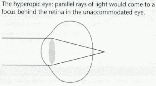 The Farsighted (Hyperopic) Eye