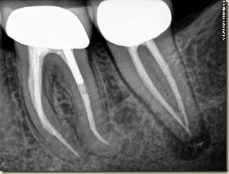 Endodontic Complexity preop