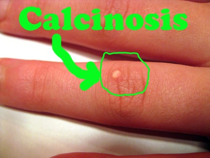 [calcinosis JM finger[5].jpg]