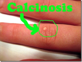 calcinosis JM finger