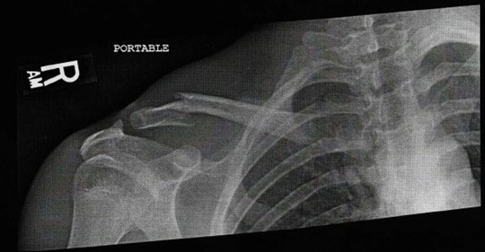 Clavicle