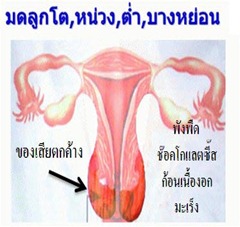 มดลูกผิดปกติ