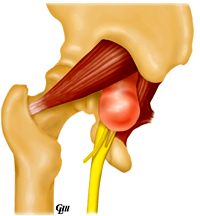 Sciatic hernia.