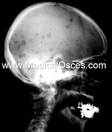 This skull X-ray is of a 78 year old man who complained of backache and lethargy..