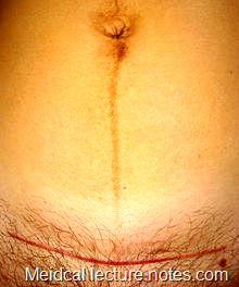 Pfannenstiel  scars  (used  for  Caesarean  section, hysterectomy,  etc.).  