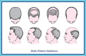 hair_loss_men_11