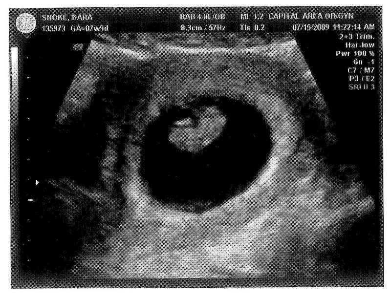Baby Besido: 7 weeks 4 days ultrasound