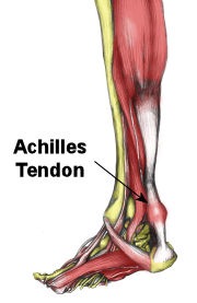 [180achilles_inflammation[3].jpg]