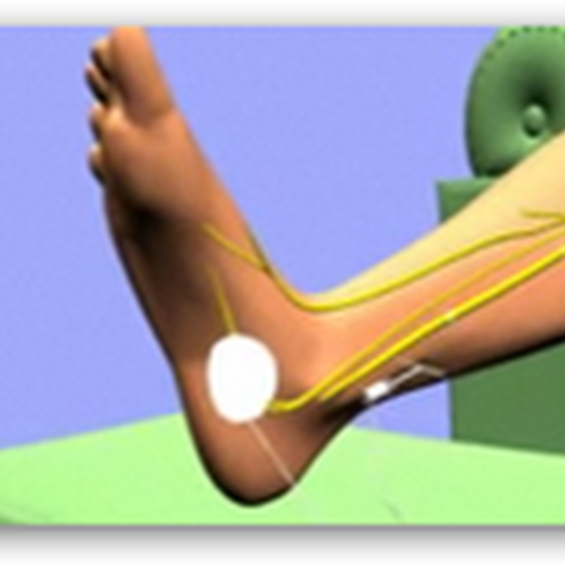 Uroplasty Neuromodulation Device Gets Approval From CMS For Reimbursement