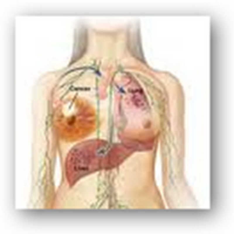 WellPoint To Standardize Clinical Guidelines for Breast Cancer Care – Offer 48 Hour Minimum Hospital Stay for Mastectomy
