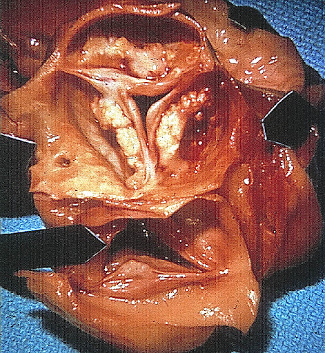 aortic stenosis picasaweb.google.com