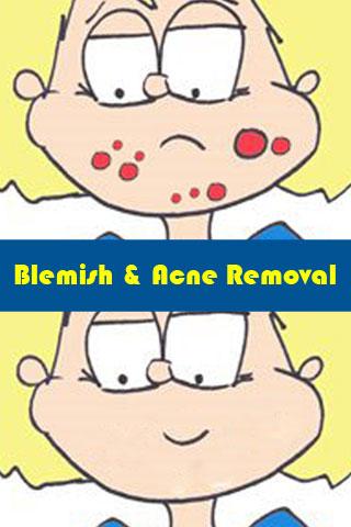 Blemish and Acne Removal