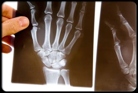 Rheumatoid Arthritis Treatment Screenshots 3