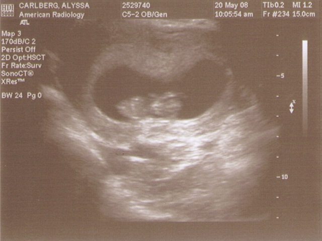 [Ultrasound-2008-05-20-a[3].jpg]