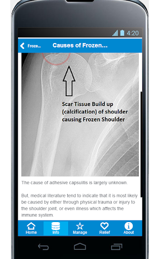 【免費健康App】Frozen Shoulder Pain Relief-APP點子