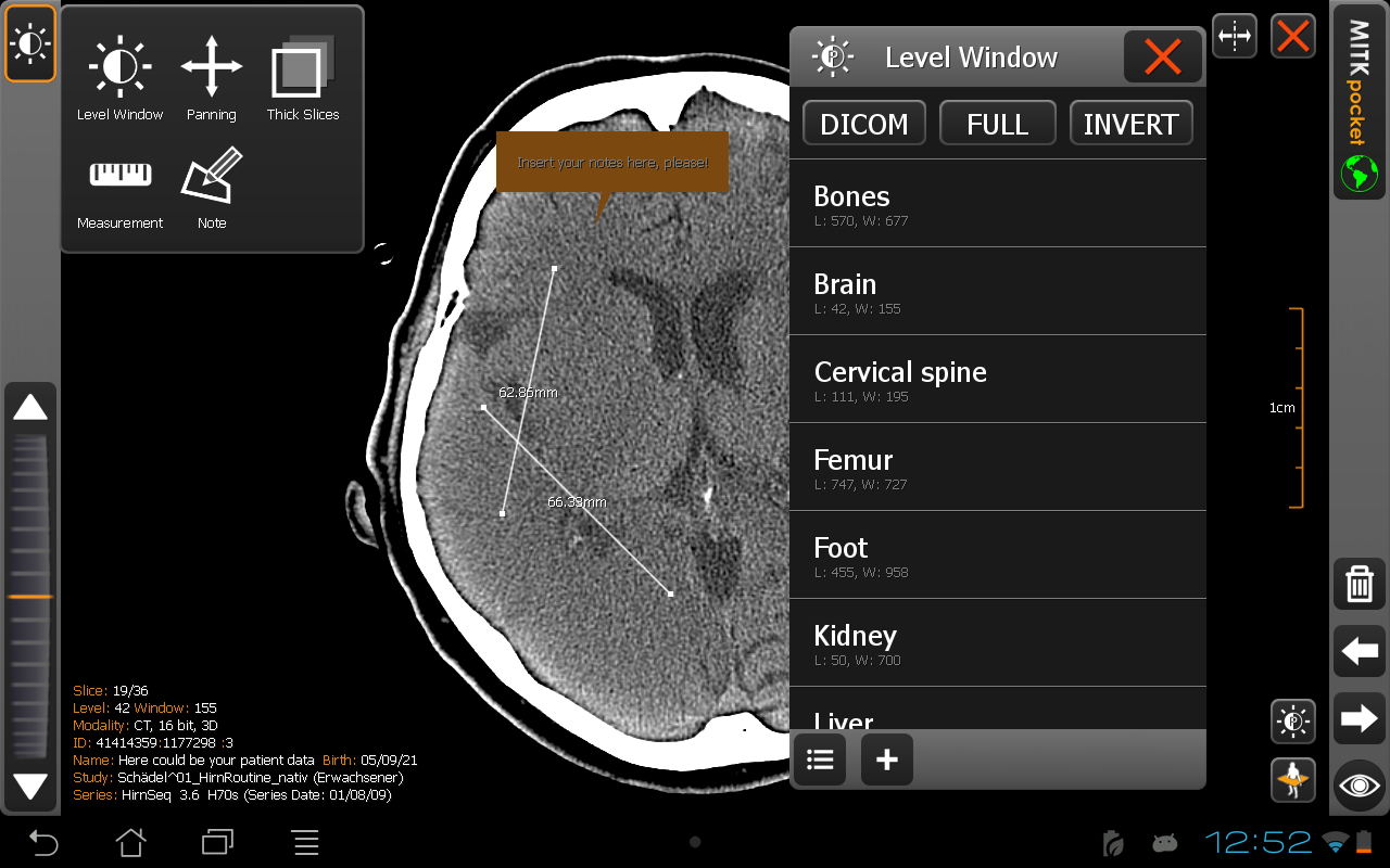 MITK pocket - DICOM Viewer - screenshot