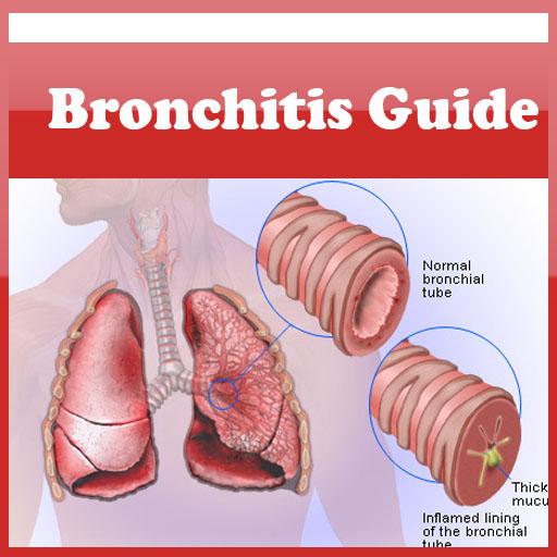 Dealing With Bronchitis