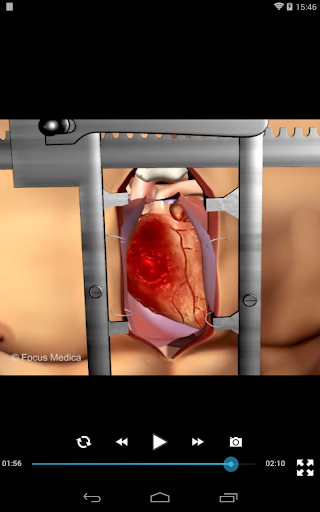 【免費醫療App】Coronary Artery Bypass Graft-APP點子