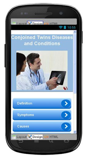 Conjoined Twins Information