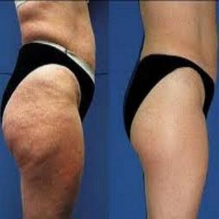 Cellulite Helper