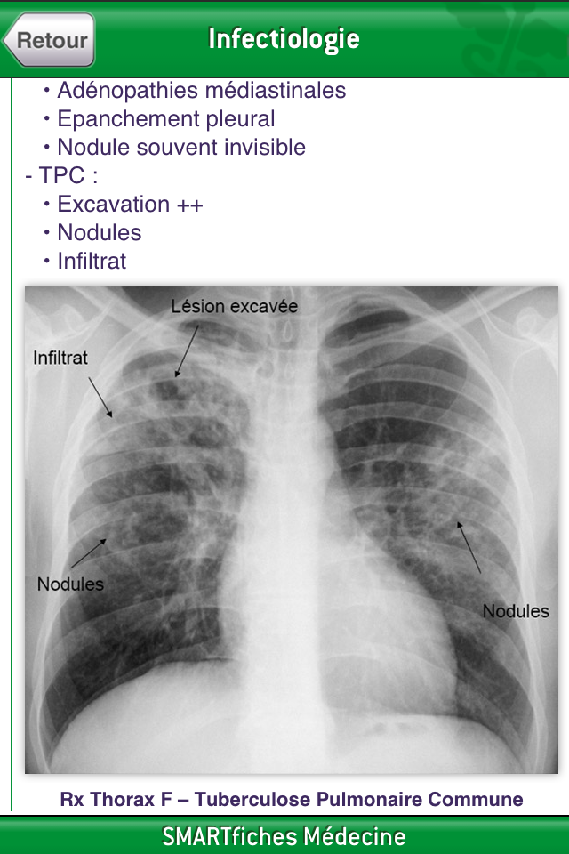 SMARTfiches Infectiologie Free Screen 2