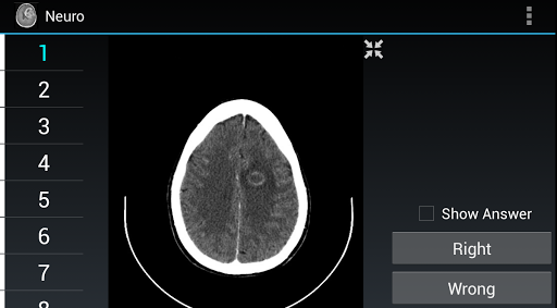 Radiology Flashcards: Neuro