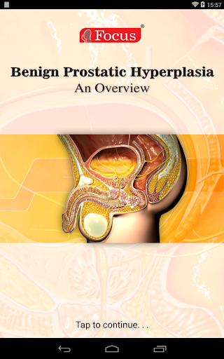 Benign Prostatic Hyperplasia