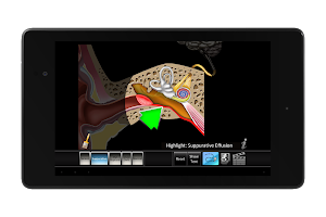 Otitis Media APK صورة لقطة الشاشة #11