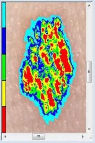 Android application Skin Mole Analysis screenshort
