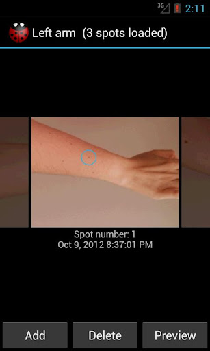 Skin Monitor: check your moles