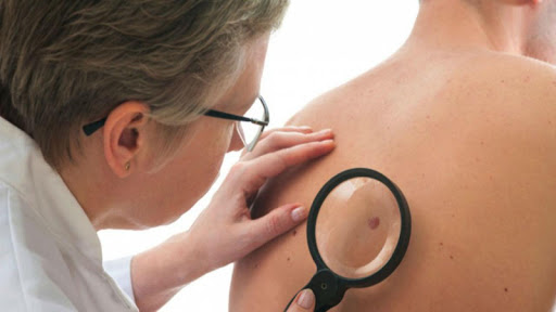 Signs of Skin Cancer